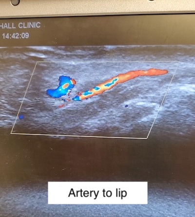 Labial artery ultrasound image