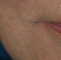 Mole removed with laser