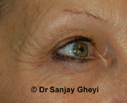 eyelid-skin-excess