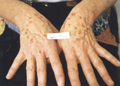 Age spots on hands