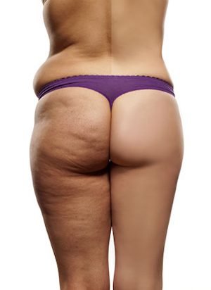 cellulite-buttocks-legs