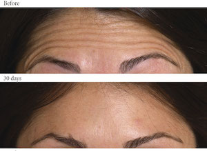 forehead-botox