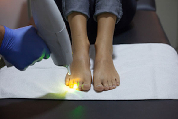 fungal-toe-nail-laser