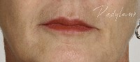 restylane lips