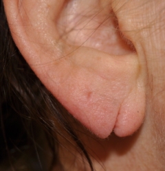 split-earlobe