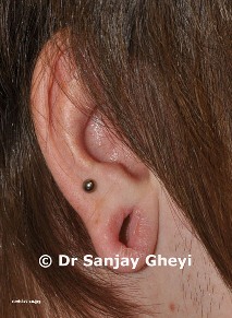 stretched earlobe